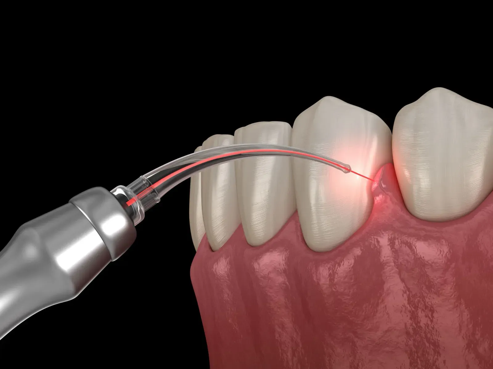 Top Benefits of Laser Dentistry in Perth - Learn more about technology